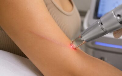 How Does Laser Scar Removal Reduce Scarring?
