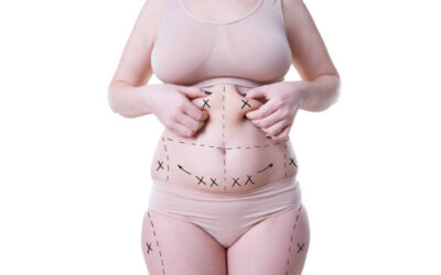 How Does Liposuction Help Define Body Curves?