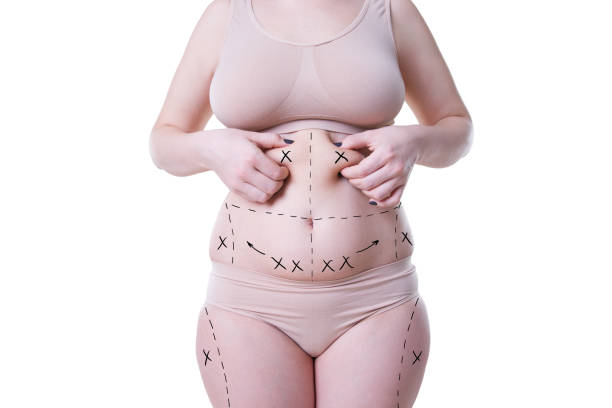 How Does Liposuction Help Define Body Curves