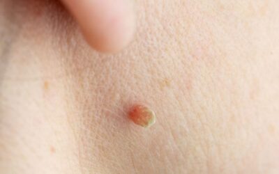 How Effective Is Professional Skin Tag Removal