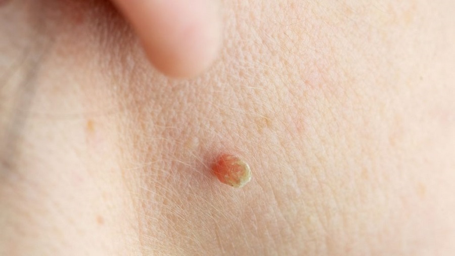 How Effective Is Professional Skin Tag Removal