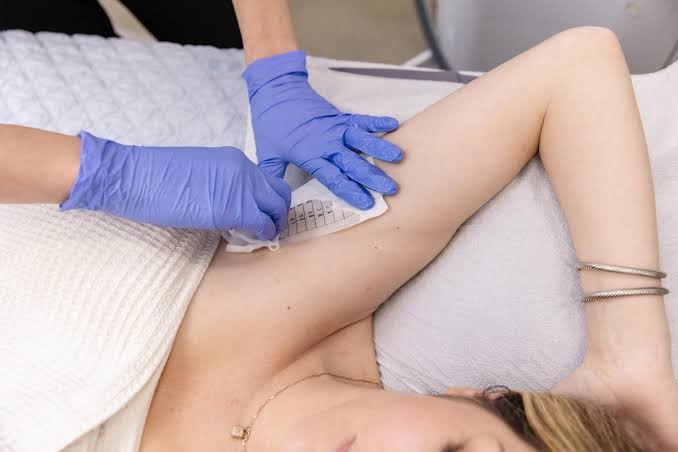 How Many MiraDry Treatment Sessions Are Needed?
