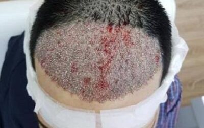 تقنيات FUE و DHI لـ زراعة الشعر في دبي داخل عيادة تجميل دبي