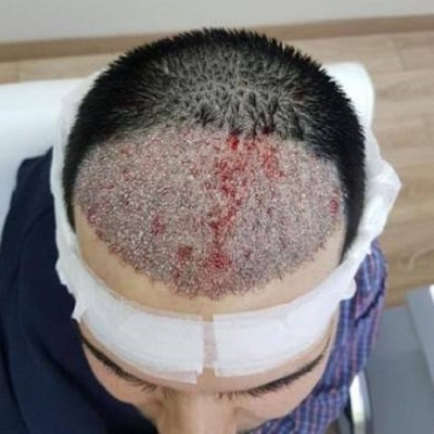 تقنيات FUE و DHI لـ زراعة الشعر في دبي داخل عيادة تجميل دبي