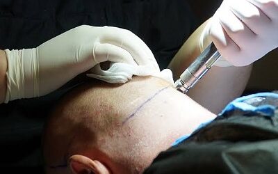 زراعة الشعر في دبي لتساقط الشعر في عيادة تجميل في دبي