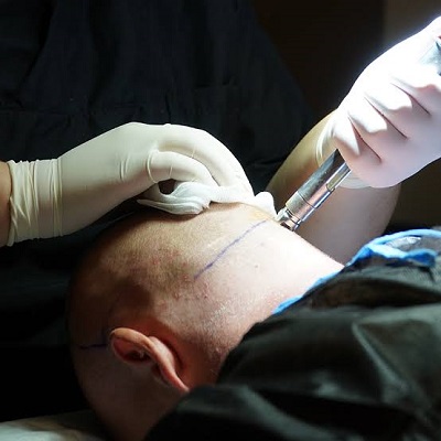 زراعة الشعر في دبي لتساقط الشعر في عيادة تجميل في دبي