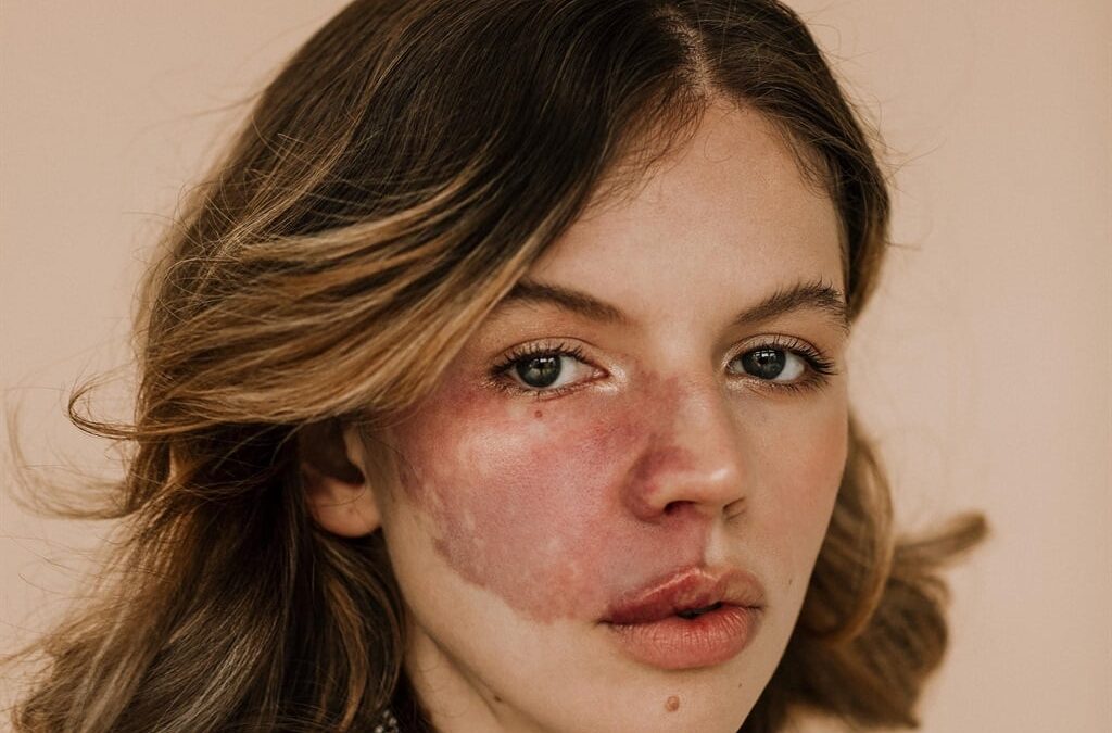 Is Birthmarks Removal Treatment Right for You?