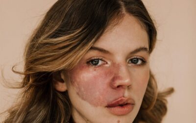 Is Birthmarks Removal Treatment Right for You?