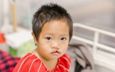 Is Cleft Lip and Palate Surgery Worth It?