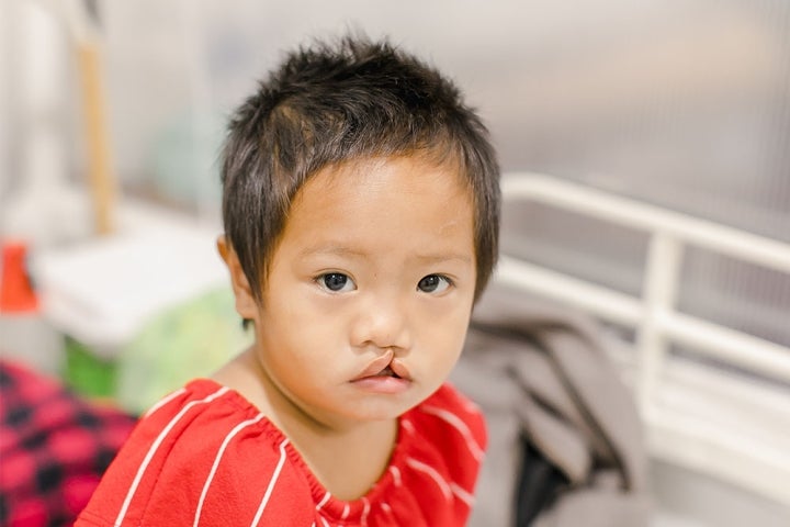 Cleft Lip and Palate Surgery in Abu Dhabi