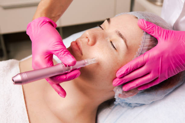 Is Dermapen Treatment Effective for Pigmentation?