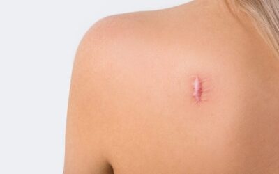 Is Keloid Treatment Suitable After Surgery?