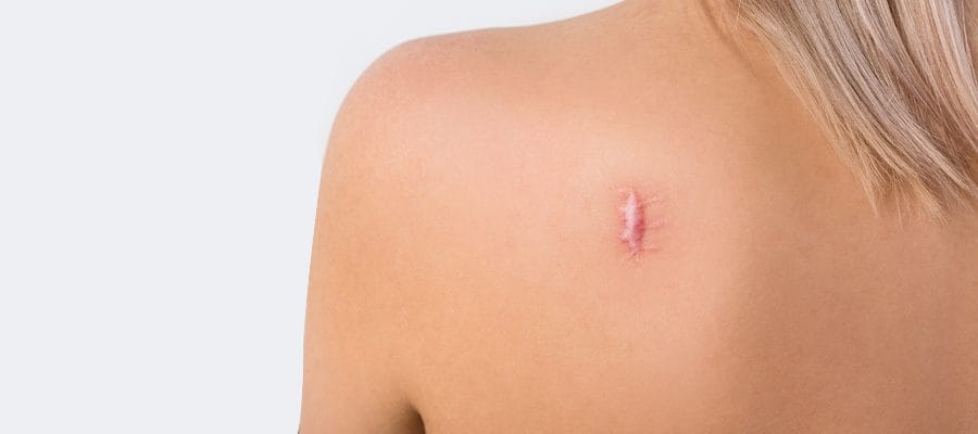 Is Keloid Treatment Suitable After Surgery?