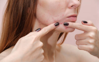 Is Laser Acne Scar Treatment Right for You?