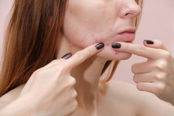 Is Laser Acne Scar Treatment Right for You