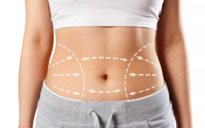 Is Mini Tummy Tuck Worth Considering?
