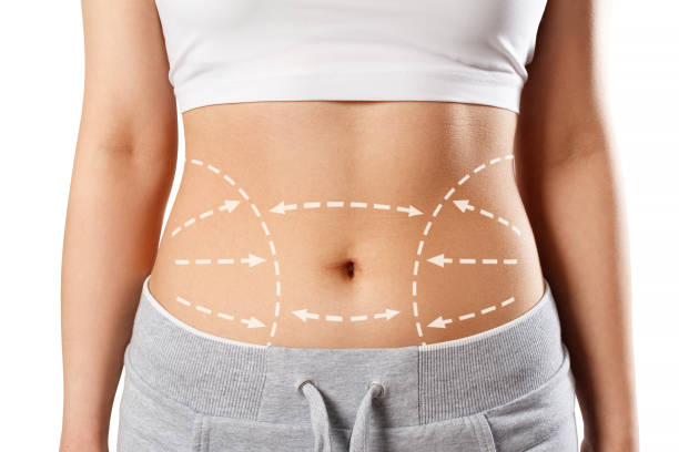 Is Mini Tummy Tuck Worth Considering