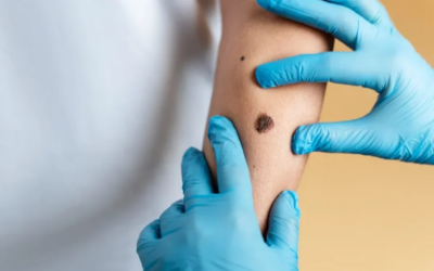 Is Mole Removal Worth Considering This Year
