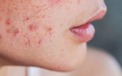 Is Subcision Treatment for Acne Scars Permanent?