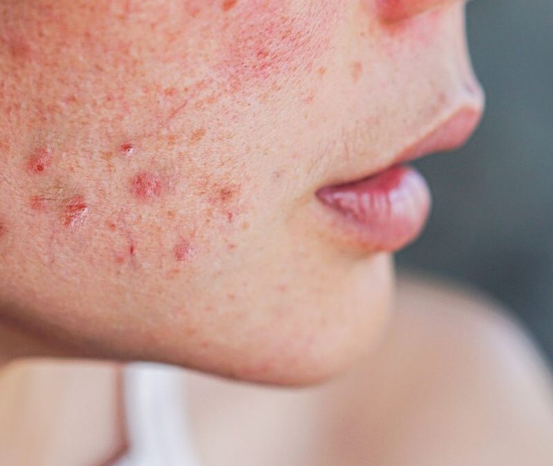 Is Subcision Treatment for Acne Scars Permanent?
