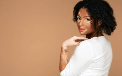 Is Vitiligo Treatment the Right Skin Solution?