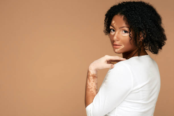 Is Vitiligo Treatment the Right Skin Solution