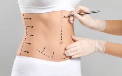 What Is Recovery After Lipo Abdominoplasty?