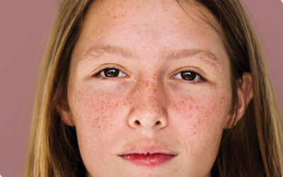What Results Can Melasma Treatment Deliver?