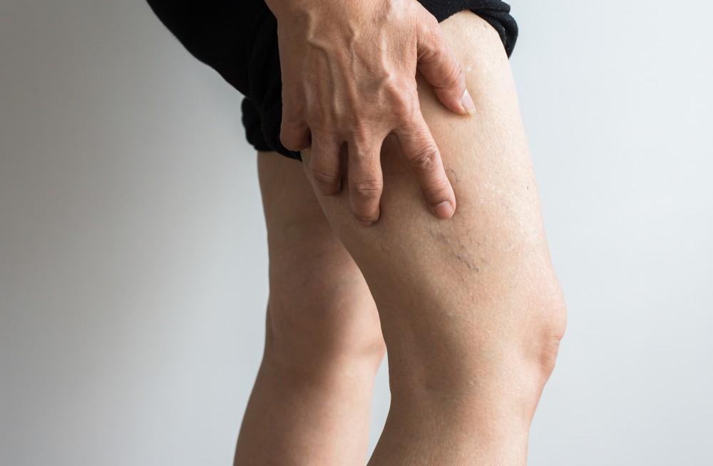 What Results Can Spider Veins Treatment Deliver?