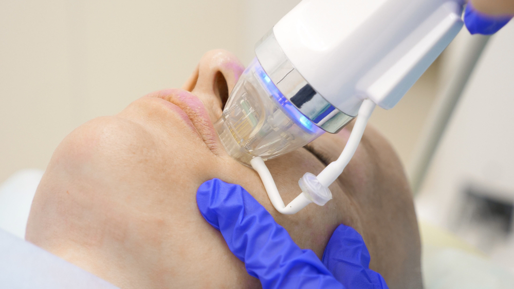 What Should You Expect After RF Micro Needling?