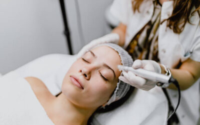 What Skin Types Benefit From Microneedling for Acne Scars