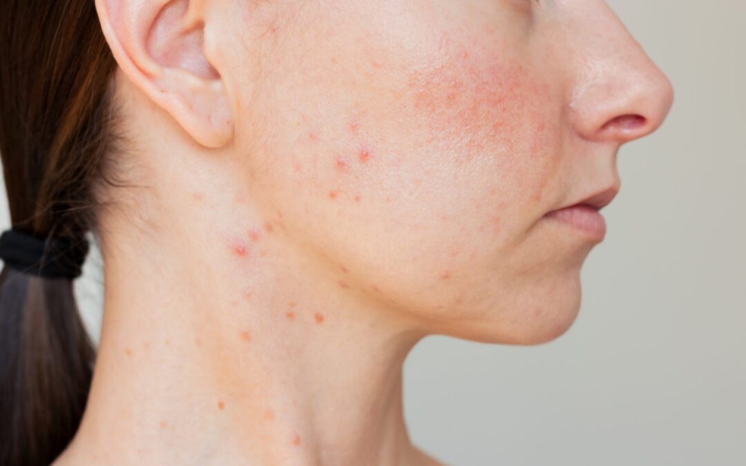 What to Expect from Skin Diseases Treatment?