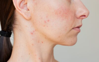 What to Expect from Skin Diseases Treatment?