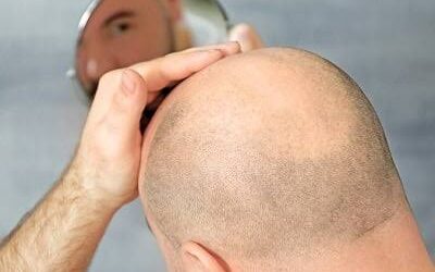 تكلفة زراعة الشعر في دبي: استثمارك الذكي لمدى الحياة في عيادة تجميل دبي