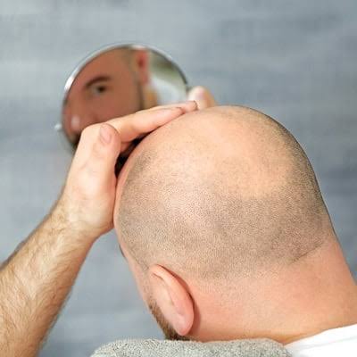تكلفة زراعة الشعر في دبي: استثمارك الذكي لمدى الحياة في عيادة تجميل دبي