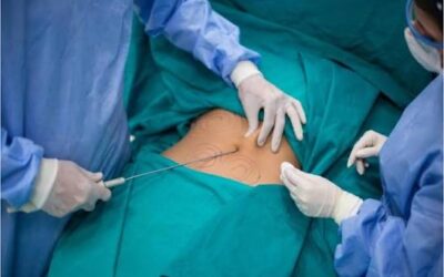 تكلفة جراحة شفط الدهون في دبي في عيادة تجميل دبي: عوامل تحديد السعر