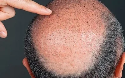 لماذا تعتبر عيادة تجميل دبي الخيار الأفضل لزراعة الشعر؟