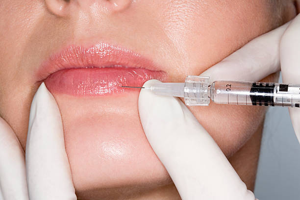 Can Lip Fillers Injection Correct Lip Asymmetry?