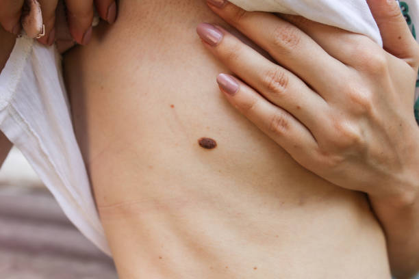 Can Warts Removal Treatment Improve Skin Appearance?