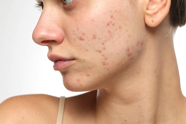 Does Laser Acne Scar Treatment Improve Skin?