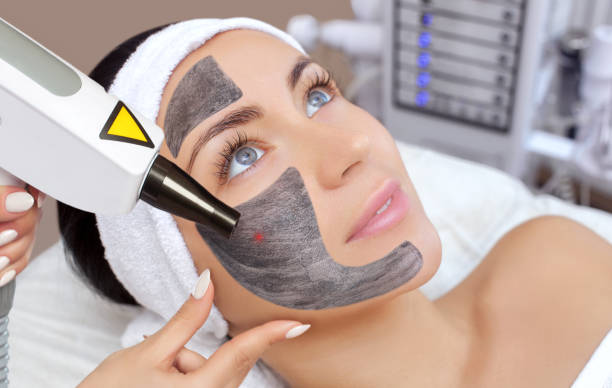 Does Laser Carbon Peeling Remove Dead Skin Cells?