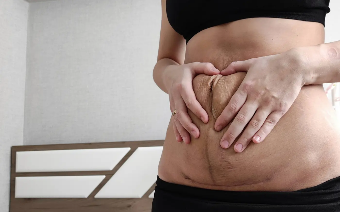 Does Mini Abdominoplasty Tighten Abdominal Muscles