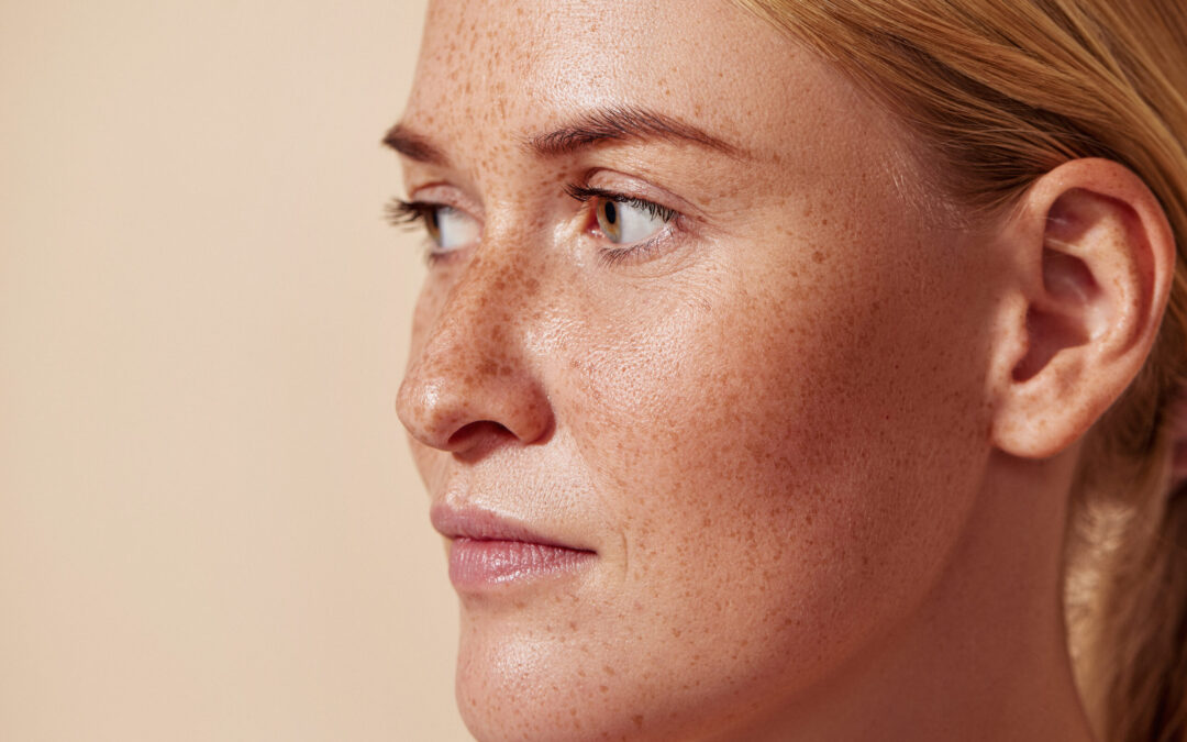 How Does Melasma Treatment Restore Clear Skin?