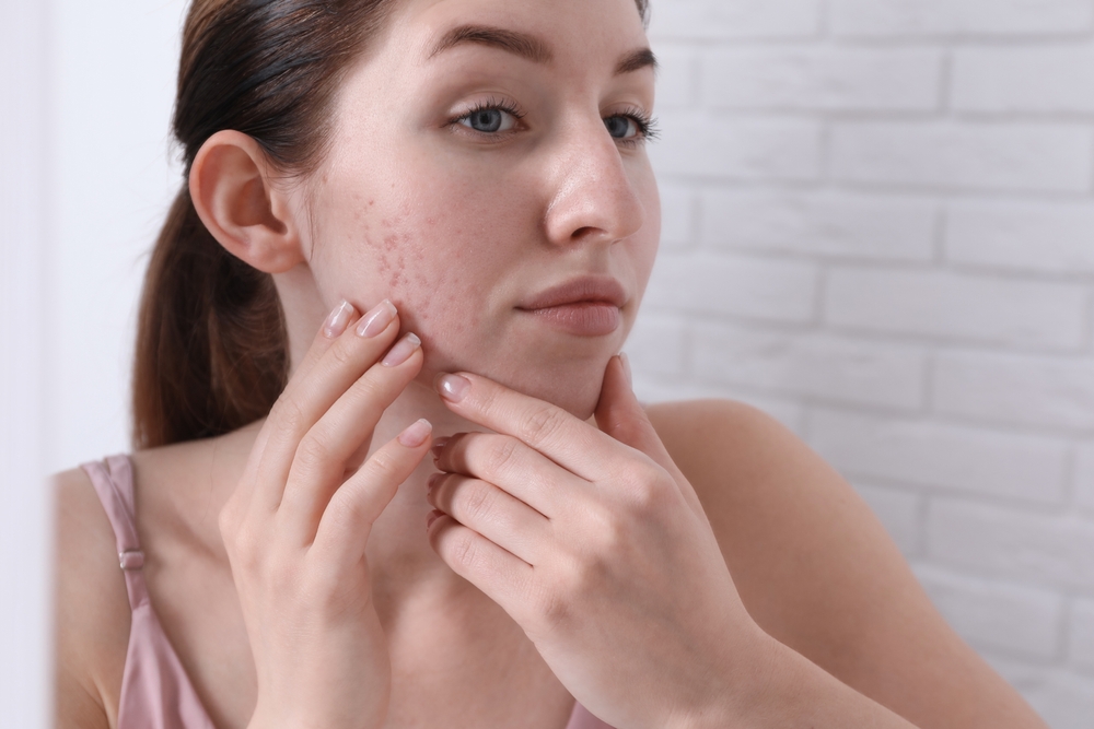 How Effective Is Laser Acne Scar Treatment
